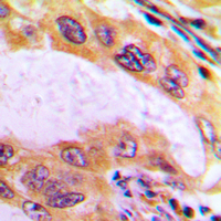 Immunohistochemical analysis of B4GALT3 staining in human liver cancer formalin fixed paraffin embedded tissue section. The section was pre-treated using heat mediated antigen retrieval with sodium citrate buffer (pH 6.0). The section was then incubated with the antibody at room temperature and detected using an HRP conjugated compact polymer system. DAB was used as the chromogen. The section was then counterstained with haematoxylin and mounted with DPX.