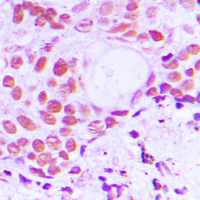 Immunohistochemical analysis of TIF1 alpha staining in human breast cancer formalin fixed paraffin embedded tissue section. The section was pre-treated using heat mediated antigen retrieval with sodium citrate buffer (pH 6.0). The section was then incubated with the antibody at room temperature and detected using an HRP conjugated compact polymer system. DAB was used as the chromogen. The section was then counterstained with haematoxylin and mounted with DPX.