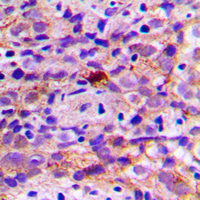 Immunohistochemical analysis of CES2 staining in human breast cancer formalin fixed paraffin embedded tissue section. The section was pre-treated using heat mediated antigen retrieval with sodium citrate buffer (pH 6.0). The section was then incubated with the antibody at room temperature and detected using an HRP conjugated compact polymer system. DAB was used as the chromogen. The section was then counterstained with haematoxylin and mounted with DPX.