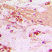 Immunohistochemical analysis of TSC22 staining in human lung cancer formalin fixed paraffin embedded tissue section. The section was pre-treated using heat mediated antigen retrieval with sodium citrate buffer (pH 6.0). The section was then incubated with the antibody at room temperature and detected using an HRP conjugated compact polymer system. DAB was used as the chromogen. The section was then counterstained with haematoxylin and mounted with DPX.