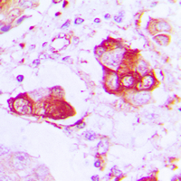 Immunohistochemical analysis of CNT2 staining in human lung cancer formalin fixed paraffin embedded tissue section. The section was pre-treated using heat mediated antigen retrieval with sodium citrate buffer (pH 6.0). The section was then incubated with the antibody at room temperature and detected using an HRP conjugated compact polymer system. DAB was used as the chromogen. The section was then counterstained with haematoxylin and mounted with DPX.