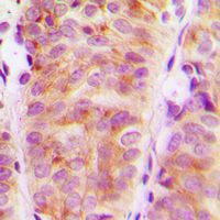 Immunohistochemical analysis of ARHGEF10 staining in human breast cancer formalin fixed paraffin embedded tissue section. The section was pre-treated using heat mediated antigen retrieval with sodium citrate buffer (pH 6.0). The section was then incubated with the antibody at room temperature and detected using an HRP conjugated compact polymer system. DAB was used as the chromogen. The section was then counterstained with haematoxylin and mounted with DPX.