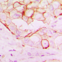 Immunohistochemical analysis of RNF144A staining in human breast cancer formalin fixed paraffin embedded tissue section. The section was pre-treated using heat mediated antigen retrieval with sodium citrate buffer (pH 6.0). The section was then incubated with the antibody at room temperature and detected using an HRP conjugated compact polymer system. DAB was used as the chromogen. The section was then counterstained with haematoxylin and mounted with DPX.