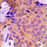 Immunohistochemical analysis of UBA2 staining in human breast cancer formalin fixed paraffin embedded tissue section. The section was pre-treated using heat mediated antigen retrieval with sodium citrate buffer (pH 6.0). The section was then incubated with the antibody at room temperature and detected using an HRP conjugated compact polymer system. DAB was used as the chromogen. The section was then counterstained with haematoxylin and mounted with DPX.