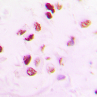 Immunohistochemical analysis of RAD50 staining in human lung cancer formalin fixed paraffin embedded tissue section. The section was pre-treated using heat mediated antigen retrieval with sodium citrate buffer (pH 6.0). The section was then incubated with the antibody at room temperature and detected using an HRP conjugated compact polymer system. DAB was used as the chromogen. The section was then counterstained with haematoxylin and mounted with DPX.