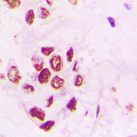 Immunohistochemical analysis of PIAS3 staining in human lung cancer formalin fixed paraffin embedded tissue section. The section was pre-treated using heat mediated antigen retrieval with sodium citrate buffer (pH 6.0). The section was then incubated with the antibody at room temperature and detected using an HRP conjugated compact polymer system. DAB was used as the chromogen. The section was then counterstained with haematoxylin and mounted with DPX.