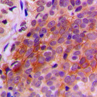 Immunohistochemical analysis of TXNRD2 staining in human breast cancer formalin fixed paraffin embedded tissue section. The section was pre-treated using heat mediated antigen retrieval with sodium citrate buffer (pH 6.0). The section was then incubated with the antibody at room temperature and detected using an HRP conjugated compact polymer system. DAB was used as the chromogen. The section was then counterstained with haematoxylin and mounted with DPX.