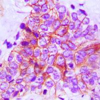 Immunohistochemical analysis of FOP staining in human breast cancer formalin fixed paraffin embedded tissue section. The section was pre-treated using heat mediated antigen retrieval with sodium citrate buffer (pH 6.0). The section was then incubated with the antibody at room temperature and detected using an HRP conjugated compact polymer system. DAB was used as the chromogen. The section was then counterstained with haematoxylin and mounted with DPX.