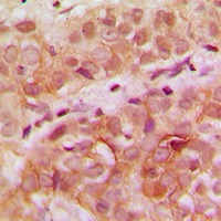 Immunohistochemical analysis of WDHD1 staining in human breast cancer formalin fixed paraffin embedded tissue section. The section was pre-treated using heat mediated antigen retrieval with sodium citrate buffer (pH 6.0). The section was then incubated with the antibody at room temperature and detected using an HRP conjugated compact polymer system. DAB was used as the chromogen. The section was then counterstained with haematoxylin and mounted with DPX.