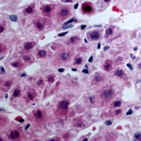 Immunohistochemical analysis of EDG7 staining in human liver cancer formalin fixed paraffin embedded tissue section. The section was pre-treated using heat mediated antigen retrieval with sodium citrate buffer (pH 6.0). The section was then incubated with the antibody at room temperature and detected using an HRP conjugated compact polymer system. DAB was used as the chromogen. The section was then counterstained with haematoxylin and mounted with DPX.