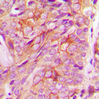 Immunohistochemical analysis of GRASP55 staining in human breast cancer formalin fixed paraffin embedded tissue section. The section was pre-treated using heat mediated antigen retrieval with sodium citrate buffer (pH 6.0). The section was then incubated with the antibody at room temperature and detected using an HRP conjugated compact polymer system. DAB was used as the chromogen. The section was then counterstained with haematoxylin and mounted with DPX.