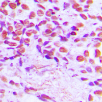 Immunohistochemical analysis of SENP3 staining in human breast cancer formalin fixed paraffin embedded tissue section. The section was pre-treated using heat mediated antigen retrieval with sodium citrate buffer (pH 6.0). The section was then incubated with the antibody at room temperature and detected using an HRP conjugated compact polymer system. DAB was used as the chromogen. The section was then counterstained with haematoxylin and mounted with DPX.