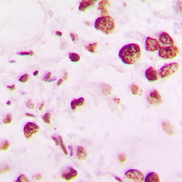 Immunohistochemical analysis of TIN2 staining in human lung cancer formalin fixed paraffin embedded tissue section. The section was pre-treated using heat mediated antigen retrieval with sodium citrate buffer (pH 6.0). The section was then incubated with the antibody at room temperature and detected using an HRP conjugated compact polymer system. DAB was used as the chromogen. The section was then counterstained with haematoxylin and mounted with DPX.