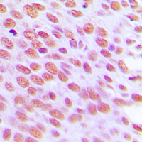 Immunohistochemical analysis of NUB1 staining in human breast cancer formalin fixed paraffin embedded tissue section. The section was pre-treated using heat mediated antigen retrieval with sodium citrate buffer (pH 6.0). The section was then incubated with the antibody at room temperature and detected using an HRP conjugated compact polymer system. DAB was used as the chromogen. The section was then counterstained with haematoxylin and mounted with DPX.