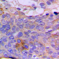 Immunohistochemical analysis of CSGALNACT1 staining in human breast cancer formalin fixed paraffin embedded tissue section. The section was pre-treated using heat mediated antigen retrieval with sodium citrate buffer (pH 6.0). The section was then incubated with the antibody at room temperature and detected using an HRP conjugated compact polymer system. DAB was used as the chromogen. The section was then counterstained with haematoxylin and mounted with DPX.