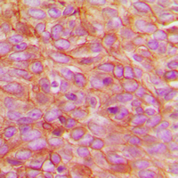 Immunohistochemical analysis of PARD3 staining in human breast cancer formalin fixed paraffin embedded tissue section. The section was pre-treated using heat mediated antigen retrieval with sodium citrate buffer (pH 6.0). The section was then incubated with the antibody at room temperature and detected using an HRP conjugated compact polymer system. DAB was used as the chromogen. The section was then counterstained with haematoxylin and mounted with DPX.