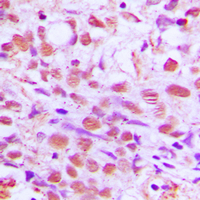 Immunohistochemical analysis of SENP2 staining in human breast cancer formalin fixed paraffin embedded tissue section. The section was pre-treated using heat mediated antigen retrieval with sodium citrate buffer (pH 6.0). The section was then incubated with the antibody at room temperature and detected using an HRP conjugated compact polymer system. DAB was used as the chromogen. The section was then counterstained with haematoxylin and mounted with DPX.