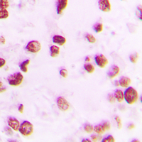 Immunohistochemical analysis of Artemis (pS516) staining in human lung cancer formalin fixed paraffin embedded tissue section. The section was pre-treated using heat mediated antigen retrieval with sodium citrate buffer (pH 6.0). The section was then incubated with the antibody at room temperature and detected using an HRP conjugated compact polymer system. DAB was used as the chromogen. The section was then counterstained with haematoxylin and mounted with DPX.