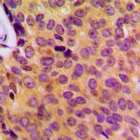 Immunohistochemical analysis of MOB3B staining in human breast cancer formalin fixed paraffin embedded tissue section. The section was pre-treated using heat mediated antigen retrieval with sodium citrate buffer (pH 6.0). The section was then incubated with the antibody at room temperature and detected using an HRP conjugated compact polymer system. DAB was used as the chromogen. The section was then counterstained with haematoxylin and mounted with DPX.