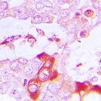 Immunohistochemical analysis of TRAF3IP3 staining in human lung cancer formalin fixed paraffin embedded tissue section. The section was pre-treated using heat mediated antigen retrieval with sodium citrate buffer (pH 6.0). The section was then incubated with the antibody at room temperature and detected using an HRP conjugated compact polymer system. DAB was used as the chromogen. The section was then counterstained with haematoxylin and mounted with DPX.