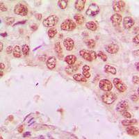 Immunohistochemical analysis of Histone Deacetylase 10 staining in human lung cancer formalin fixed paraffin embedded tissue section. The section was pre-treated using heat mediated antigen retrieval with sodium citrate buffer (pH 6.0). The section was then incubated with the antibody at room temperature and detected using an HRP conjugated compact polymer system. DAB was used as the chromogen. The section was then counterstained with haematoxylin and mounted with DPX.