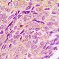 Immunohistochemical analysis of Cytochrome P450 2U1 staining in human breast cancer formalin fixed paraffin embedded tissue section. The section was pre-treated using heat mediated antigen retrieval with sodium citrate buffer (pH 6.0). The section was then incubated with the antibody at room temperature and detected using an HRP conjugated compact polymer system. DAB was used as the chromogen. The section was then counterstained with haematoxylin and mounted with DPX.
