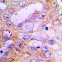 Immunohistochemical analysis of Caspase 12 staining in human lung cancer formalin fixed paraffin embedded tissue section. The section was pre-treated using heat mediated antigen retrieval with sodium citrate buffer (pH 6.0). The section was then incubated with the antibody at room temperature and detected using an HRP conjugated compact polymer system. DAB was used as the chromogen. The section was then counterstained with haematoxylin and mounted with DPX.