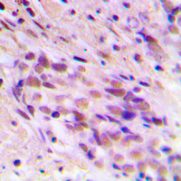 Immunohistochemical analysis of CDYL2 staining in human breast cancer formalin fixed paraffin embedded tissue section. The section was pre-treated using heat mediated antigen retrieval with sodium citrate buffer (pH 6.0). The section was then incubated with the antibody at room temperature and detected using an HRP conjugated compact polymer system. DAB was used as the chromogen. The section was then counterstained with haematoxylin and mounted with DPX.
