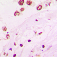 Immunohistochemical analysis of HKR1 staining in human lung cancer formalin fixed paraffin embedded tissue section. The section was pre-treated using heat mediated antigen retrieval with sodium citrate buffer (pH 6.0). The section was then incubated with the antibody at room temperature and detected using an HRP conjugated compact polymer system. DAB was used as the chromogen. The section was then counterstained with haematoxylin and mounted with DPX.