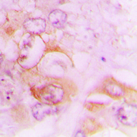 Immunohistochemical analysis of Septin 7 staining in human lung cancer formalin fixed paraffin embedded tissue section. The section was pre-treated using heat mediated antigen retrieval with sodium citrate buffer (pH 6.0). The section was then incubated with the antibody at room temperature and detected using an HRP conjugated compact polymer system. DAB was used as the chromogen. The section was then counterstained with haematoxylin and mounted with DPX.