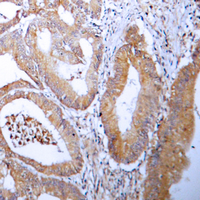 Immunohistochemical analysis of ACC alpha staining in human colon cancer formalin fixed paraffin embedded tissue section. The section was pre-treated using heat mediated antigen retrieval with sodium citrate buffer (pH 6.0). The section was then incubated with the antibody at room temperature and detected using an HRP conjugated compact polymer system. DAB was used as the chromogen. The section was then counterstained with haematoxylin and mounted with DPX.