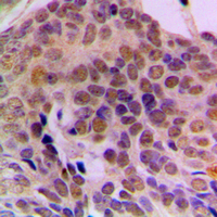 Immunohistochemical analysis of ADAR1 staining in human breast cancer formalin fixed paraffin embedded tissue section. The section was pre-treated using heat mediated antigen retrieval with sodium citrate buffer (pH 6.0). The section was then incubated with the antibody at room temperature and detected using an HRP conjugated compact polymer system. DAB was used as the chromogen. The section was then counterstained with haematoxylin and mounted with DPX.
