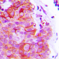 Immunohistochemical analysis of Alpha-2C Adrenergic Receptor staining in human breast cancer formalin fixed paraffin embedded tissue section. The section was pre-treated using heat mediated antigen retrieval with sodium citrate buffer (pH 6.0). The section was then incubated with the antibody at room temperature and detected using an HRP conjugated compact polymer system. DAB was used as the chromogen. The section was then counterstained with haematoxylin and mounted with DPX.