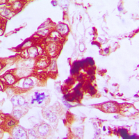 Immunohistochemical analysis of Aquaporin 3 staining in human lung cancer formalin fixed paraffin embedded tissue section. The section was pre-treated using heat mediated antigen retrieval with sodium citrate buffer (pH 6.0). The section was then incubated with the antibody at room temperature and detected using an HRP conjugated compact polymer system. DAB was used as the chromogen. The section was then counterstained with haematoxylin and mounted with DPX.