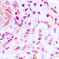 Immunohistochemical analysis of BARD1 staining in human lung cancer formalin fixed paraffin embedded tissue section. The section was pre-treated using heat mediated antigen retrieval with sodium citrate buffer (pH 6.0). The section was then incubated with the antibody at room temperature and detected using an HRP conjugated compact polymer system. DAB was used as the chromogen. The section was then counterstained with haematoxylin and mounted with DPX.