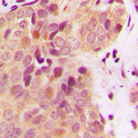 Immunohistochemical analysis of BRCA2 staining in human breast cancer formalin fixed paraffin embedded tissue section. The section was pre-treated using heat mediated antigen retrieval with sodium citrate buffer (pH 6.0). The section was then incubated with the antibody at room temperature and detected using an HRP conjugated compact polymer system. DAB was used as the chromogen. The section was then counterstained with haematoxylin and mounted with DPX.