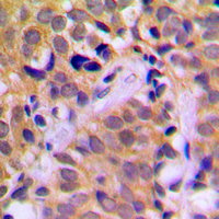 Immunohistochemical analysis of CHRNA1 staining in human prostate cancer formalin fixed paraffin embedded tissue section. The section was pre-treated using heat mediated antigen retrieval with sodium citrate buffer (pH 6.0). The section was then incubated with the antibody at room temperature and detected using an HRP conjugated compact polymer system. DAB was used as the chromogen. The section was then counterstained with haematoxylin and mounted with DPX.