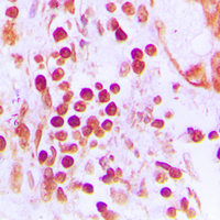 Immunohistochemical analysis of CstF-50 staining in human prostate cancer formalin fixed paraffin embedded tissue section. The section was pre-treated using heat mediated antigen retrieval with sodium citrate buffer (pH 6.0). The section was then incubated with the antibody at room temperature and detected using an HRP conjugated compact polymer system. DAB was used as the chromogen. The section was then counterstained with haematoxylin and mounted with DPX.
