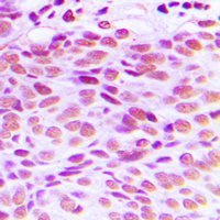 Immunohistochemical analysis of GATA4 staining in human breast cancer formalin fixed paraffin embedded tissue section. The section was pre-treated using heat mediated antigen retrieval with sodium citrate buffer (pH 6.0). The section was then incubated with the antibody at room temperature and detected using an HRP conjugated compact polymer system. DAB was used as the chromogen. The section was then counterstained with haematoxylin and mounted with DPX.
