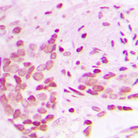 Immunohistochemical analysis of AF4 staining in human breast cancer formalin fixed paraffin embedded tissue section. The section was pre-treated using heat mediated antigen retrieval with sodium citrate buffer (pH 6.0). The section was then incubated with the antibody at room temperature and detected using an HRP conjugated compact polymer system. DAB was used as the chromogen. The section was then counterstained with haematoxylin and mounted with DPX.