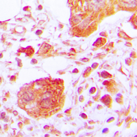 Immunohistochemical analysis of PLC gamma 1 (pY783) staining in human lung cancer formalin fixed paraffin embedded tissue section. The section was pre-treated using heat mediated antigen retrieval with sodium citrate buffer (pH 6.0). The section was then incubated with the antibody at room temperature and detected using an HRP conjugated compact polymer system. DAB was used as the chromogen. The section was then counterstained with haematoxylin and mounted with DPX.