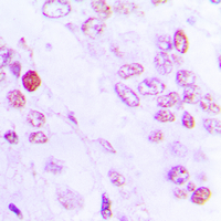 Immunohistochemical analysis of C/EBP beta staining in human lung cancer formalin fixed paraffin embedded tissue section. The section was pre-treated using heat mediated antigen retrieval with sodium citrate buffer (pH 6.0). The section was then incubated with the antibody at room temperature and detected using an HRP conjugated compact polymer system. DAB was used as the chromogen. The section was then counterstained with haematoxylin and mounted with DPX.