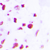 Immunohistochemical analysis of C/EBP beta staining in human lung cancer formalin fixed paraffin embedded tissue section. The section was pre-treated using heat mediated antigen retrieval with sodium citrate buffer (pH 6.0). The section was then incubated with the antibody at room temperature and detected using an HRP conjugated compact polymer system. DAB was used as the chromogen. The section was then counterstained with haematoxylin and mounted with DPX.