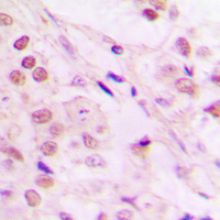Immunohistochemical analysis of TCEB3 staining in human lung cancer formalin fixed paraffin embedded tissue section. The section was pre-treated using heat mediated antigen retrieval with sodium citrate buffer (pH 6.0). The section was then incubated with the antibody at room temperature and detected using an HRP conjugated compact polymer system. DAB was used as the chromogen. The section was then counterstained with haematoxylin and mounted with DPX.