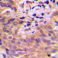Immunohistochemical analysis of CDKL2 staining in human breast cancer formalin fixed paraffin embedded tissue section. The section was pre-treated using heat mediated antigen retrieval with sodium citrate buffer (pH 6.0). The section was then incubated with the antibody at room temperature and detected using an HRP conjugated compact polymer system. DAB was used as the chromogen. The section was then counterstained with haematoxylin and mounted with DPX.