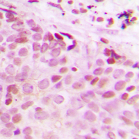 Immunohistochemical analysis of Separase (pS801) staining in human breast cancer formalin fixed paraffin embedded tissue section. The section was pre-treated using heat mediated antigen retrieval with sodium citrate buffer (pH 6.0). The section was then incubated with the antibody at room temperature and detected using an HRP conjugated compact polymer system. DAB was used as the chromogen. The section was then counterstained with haematoxylin and mounted with DPX.
