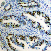 Immunohistochemical analysis of ZEB2 staining in human colon cancer formalin fixed paraffin embedded tissue section. The section was pre-treated using heat mediated antigen retrieval with sodium citrate buffer (pH 6.0). The section was then incubated with the antibody at room temperature and detected using an HRP conjugated compact polymer system. DAB was used as the chromogen. The section was then counterstained with haematoxylin and mounted with DPX.