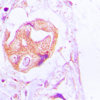 Immunohistochemical analysis of PALLD staining in human lung cancer formalin fixed paraffin embedded tissue section. The section was pre-treated using heat mediated antigen retrieval with sodium citrate buffer (pH 6.0). The section was then incubated with the antibody at room temperature and detected using an HRP conjugated compact polymer system. DAB was used as the chromogen. The section was then counterstained with haematoxylin and mounted with DPX.