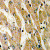 Immunohistochemical analysis of ACSL6 staining in human liver cancer formalin fixed paraffin embedded tissue section. The section was pre-treated using heat mediated antigen retrieval with sodium citrate buffer (pH 6.0). The section was then incubated with the antibody at room temperature and detected using an HRP conjugated compact polymer system. DAB was used as the chromogen. The section was then counterstained with haematoxylin and mounted with DPX.