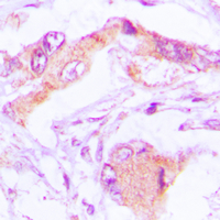 Immunohistochemical analysis of MRPL13 staining in human lung formalin fixed paraffin embedded tissue section. The section was pre-treated using heat mediated antigen retrieval with sodium citrate buffer (pH 6.0). The section was then incubated with the antibody at room temperature and detected using an HRP conjugated compact polymer system. DAB was used as the chromogen. The section was then counterstained with haematoxylin and mounted with DPX.